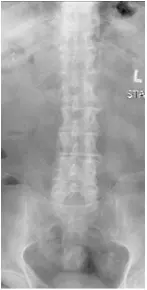 X-rays and MRI of the Lumbar spine showed L4-5 degenerative spondylolisthesis