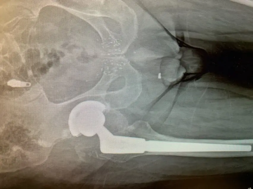 Case Study - Revision Hip 1b