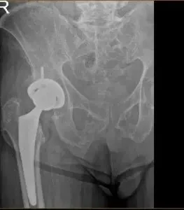 Radiografía de una prótesis de cadera