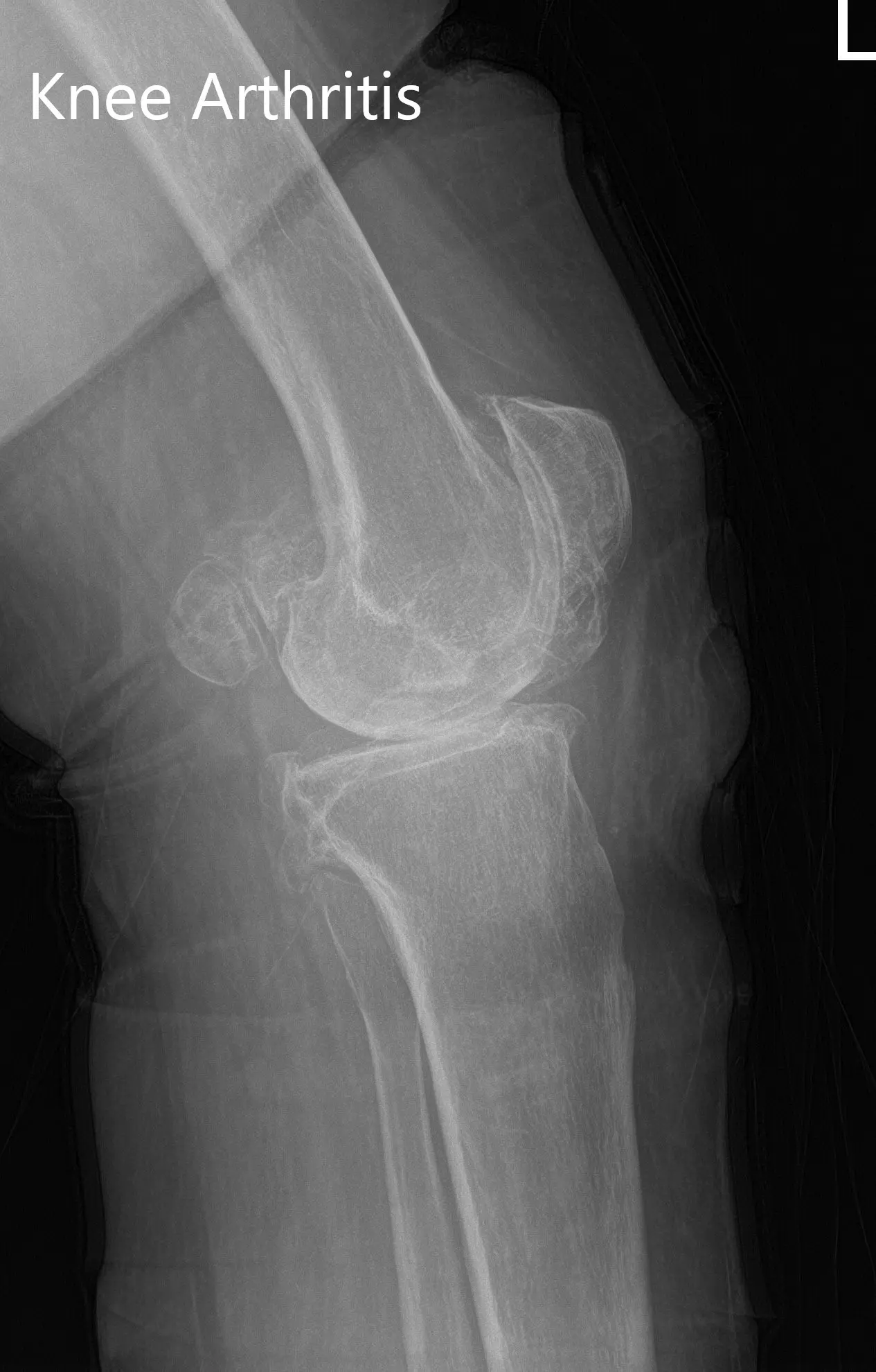 Preoperative X-ray of the left knee showing AP and lateral views - img 2
