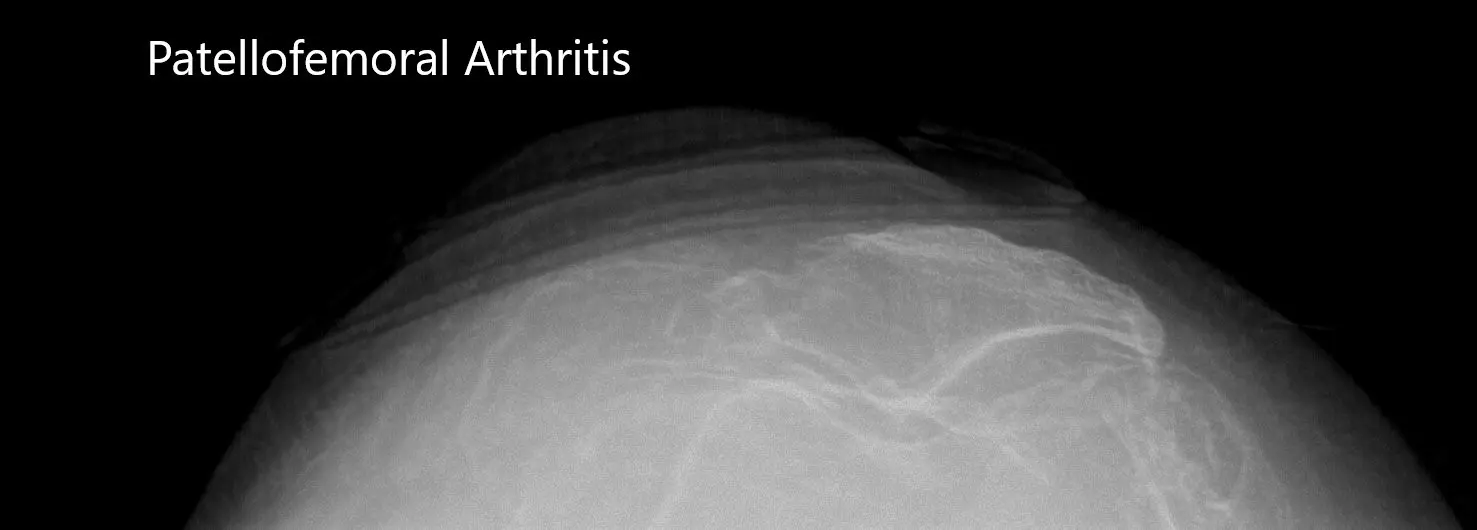 Preoperative merchant views of the bilateral patella showing severe osteoarthritis of the patellofemoral compartment - img 2 Preoperative merchant views of the bilateral patella showing severe osteoarthritis of the patellofemoral compartment - img 2