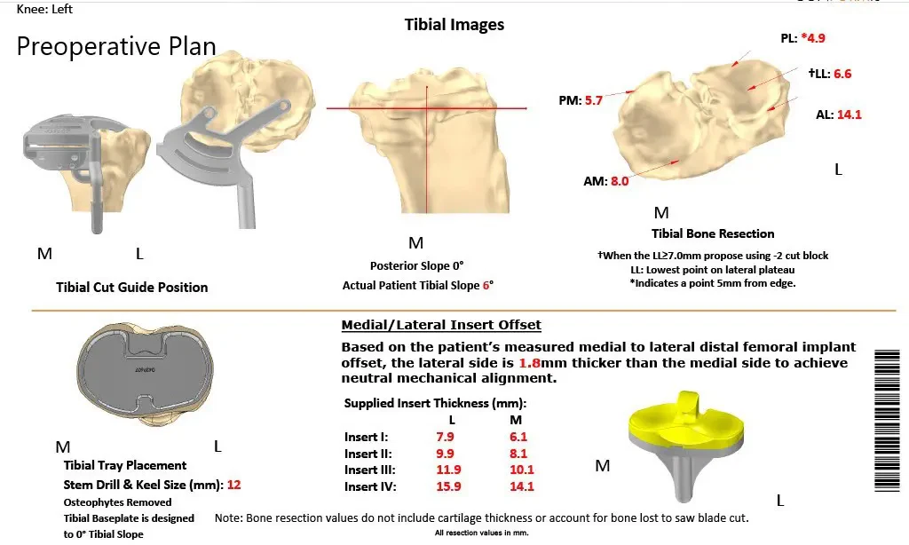 Complete Orthopedics patient specific surgical plan for a Customized Left Knee Replacement in an 81-year-old patient