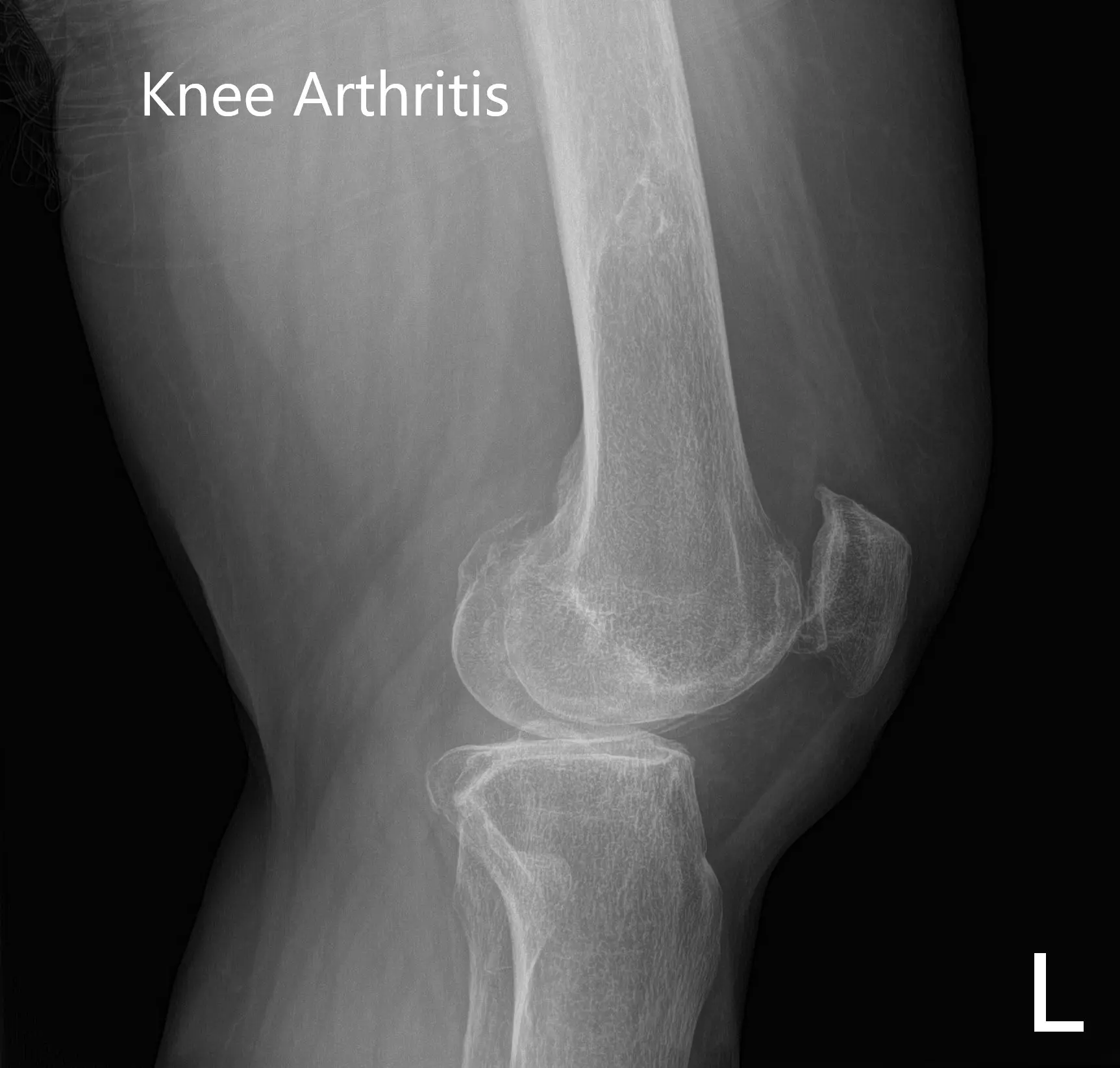 Radiografía preoperatoria que muestra imágenes AP e laterales de la rodilla izquierda - img 2