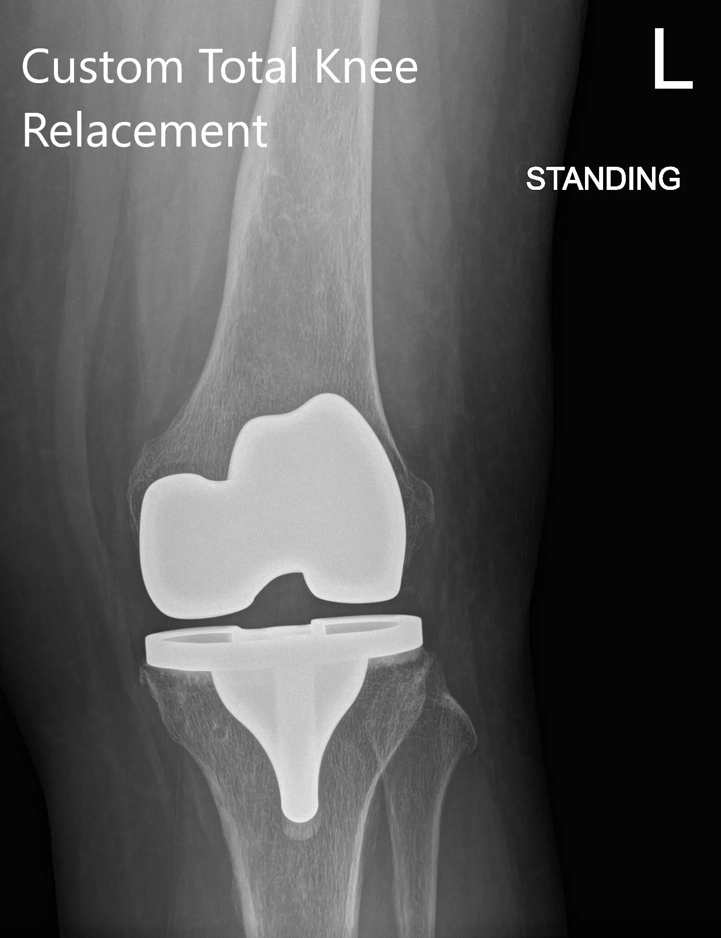 Radiografía postoperatoria que muestra PA y vista lateral de la rodilla izquierda