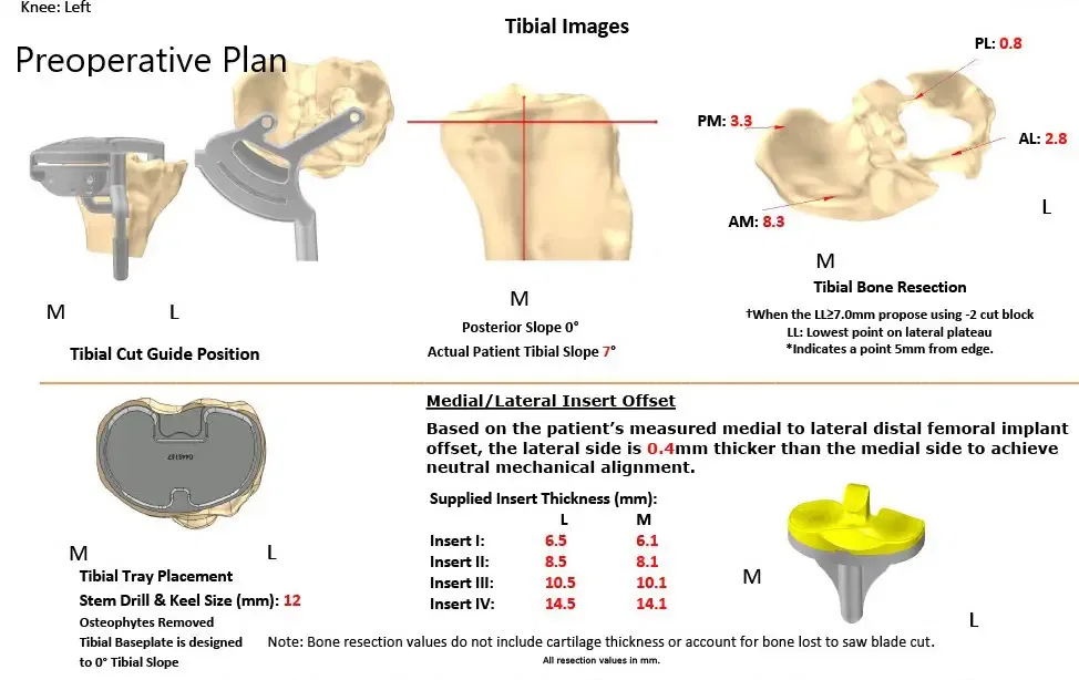 Complete Orthopedics patient specific surgical plan for a Custom Total Knee Replacement in Left Knee Arthritis with prior Hardware on the Lateral Tibial Plateau