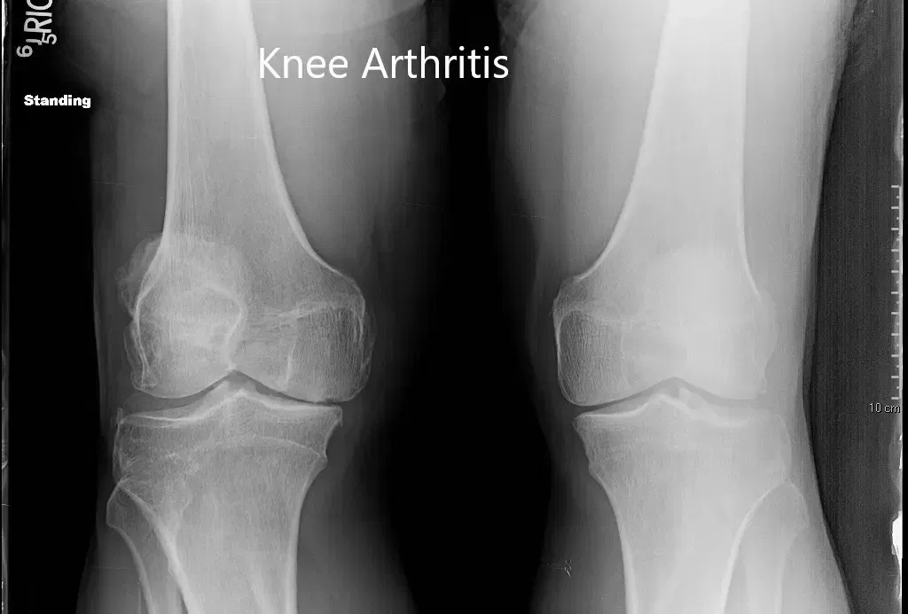 Preoperative X-ray of both the knees in anteroposterior view Preoperative X-ray of both the knees in anteroposterior view