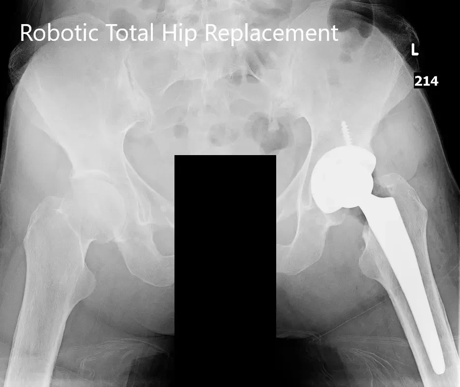 Postoperative X-ray of the pelvis with both hip joints in the AP view Postoperative X-ray of the pelvis with both hip joints in the AP view
