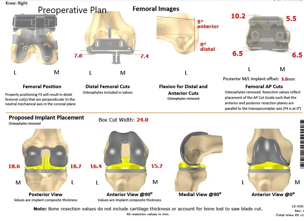 Plan quirúrgico específico para pacientes de Ortopedia Completa para una Artroplastia Total de Rodilla Personalizada Izquierda en un hombre de 68 años - escaneo 2