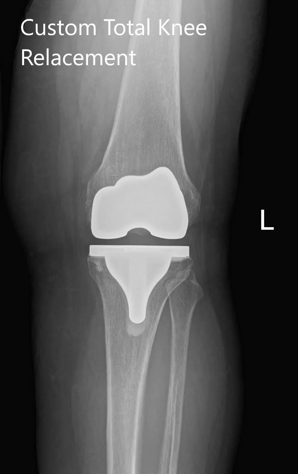 Radiografía postoperatoria de la rodilla izquierda que muestra visión AP y lateral - img 2
