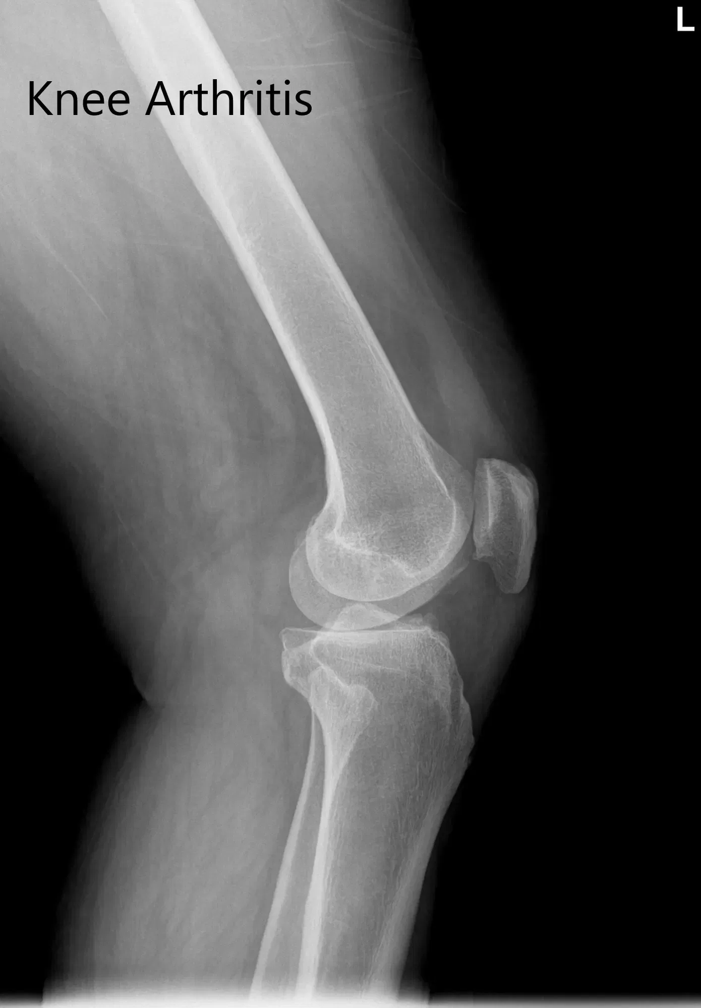 Radiografía preoperatoria de la rodilla izquierda que mostró visión AP y lateral