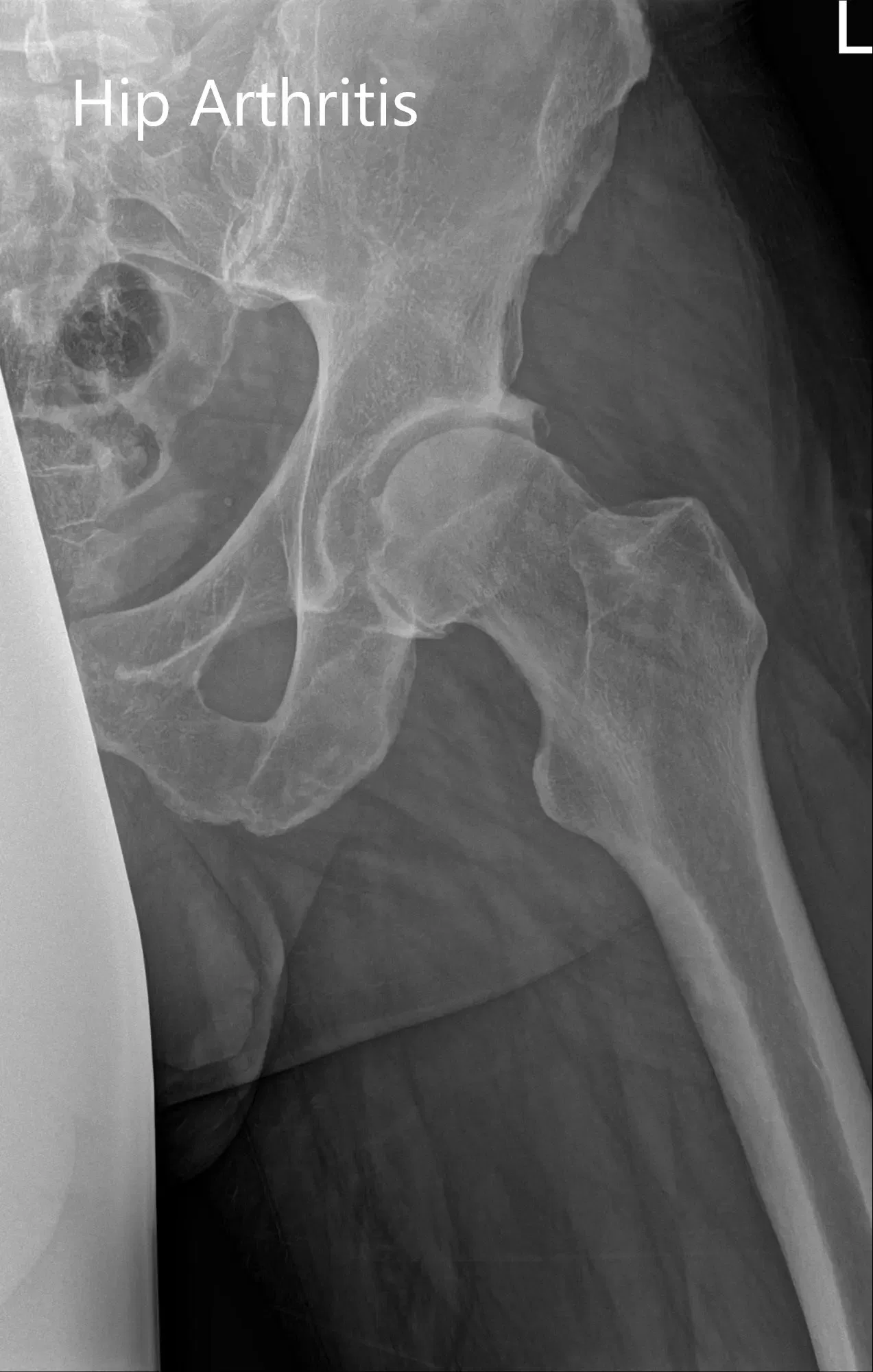 Preoperative X-ray of the pelvis AP view and the lateral view of the left hip - img 2
