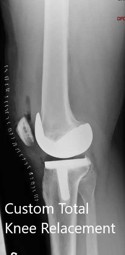 Radiografía postoperatoria que muestra la vista lateral de la rodilla derecha e izquierda