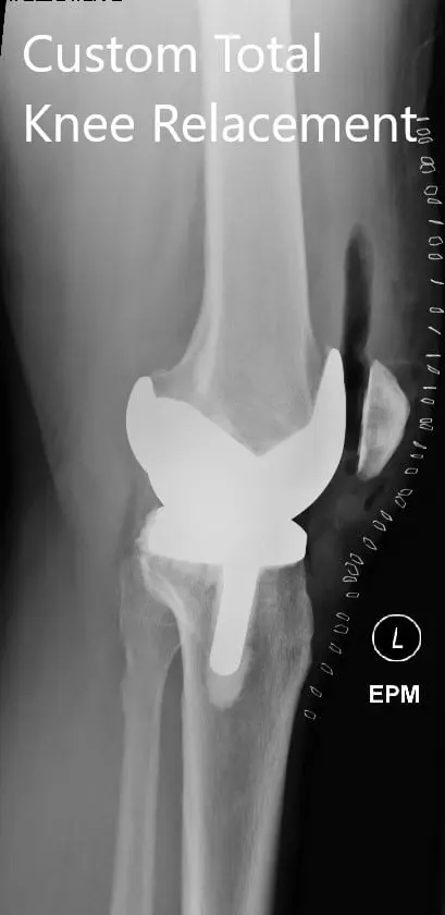 Radiografía postoperatoria que muestra la vista lateral de la rodilla derecha e izquierda - img 2