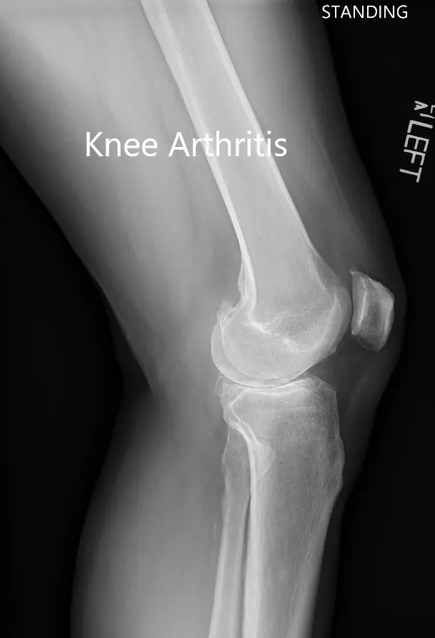 Radiografía preoperatoria que muestra la vista lateral de la articulación de la rodilla izquierda y derecha