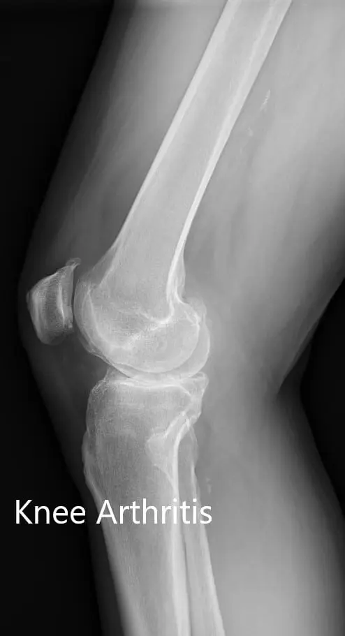 Radiografía preoperatoria que muestra la vista lateral de la articulación de la rodilla izquierda y derecha - img 2