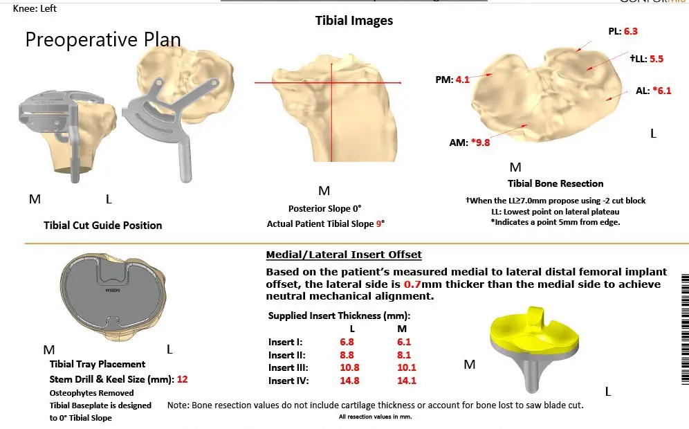 Plan quirúrgico completo de ortopedia específico para paciente para un reemplazo bilateral personalizado de rodilla total en una mujer de 72 años