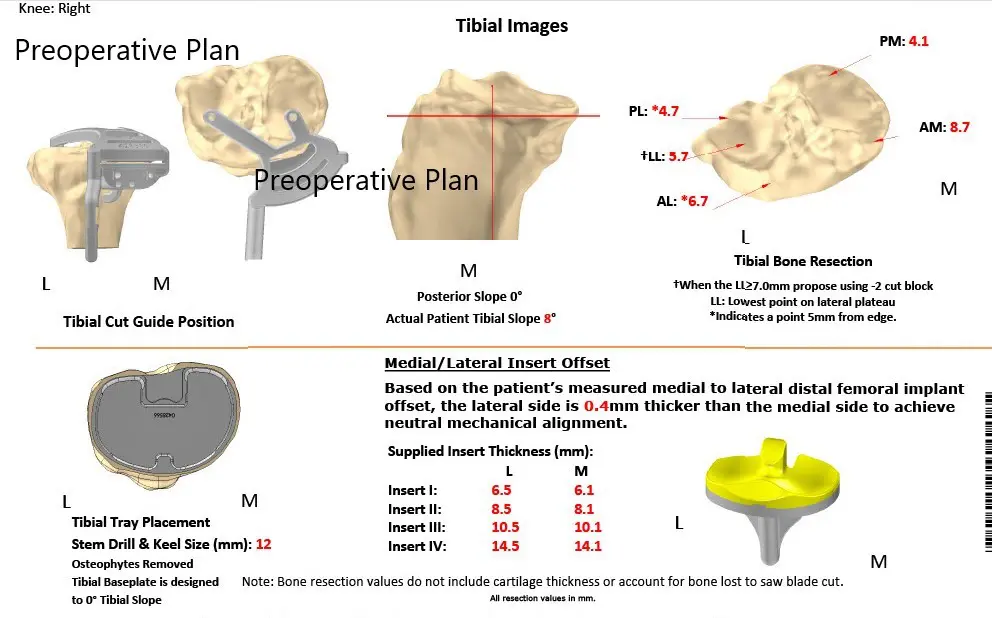 Plan quirúrgico completo específico para pacientes en ortopedia para un reemplazo bilateral personalizado de rodilla total en una mujer de 72 años - ecografía 3
