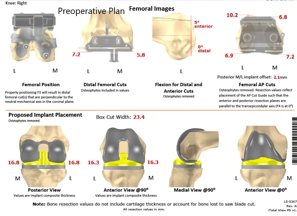 Plan quirúrgico completo específico para paciente en ortopedia para un reemplazo bilateral personalizado de rodilla total en una mujer de 72 años - ecografía 4