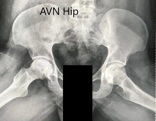 Radiografía preoperatoria de la pelvis con ambas caderas en la vista lateral con patas de rana mostrando la NVA de ambas caderas