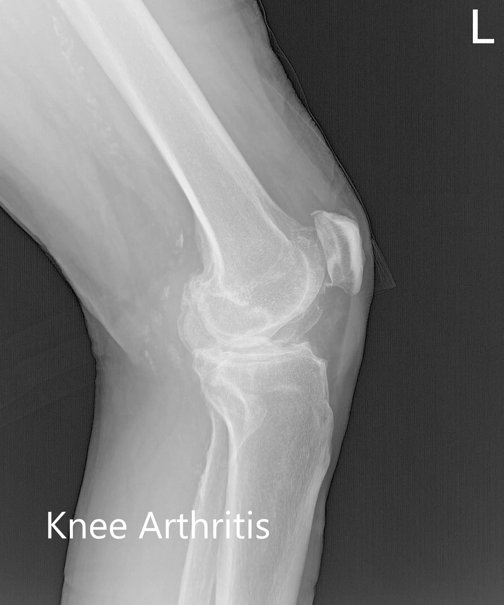Preoperative X-ray of the left knee showing AP, lateral and merchant views - img 2 Preoperative X-ray of the left knee showing AP, lateral and merchant views - img 2