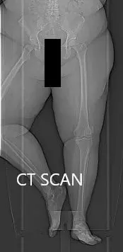 Topographic CT images of the weight-bearing Right and Left knee respectively Topographic CT images of the weight-bearing Right and Left knee respectively