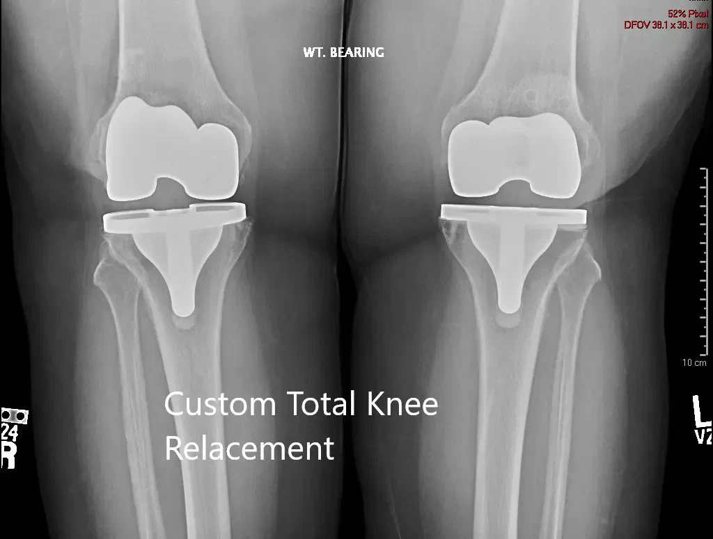Postoperative X-ray showing the AP view of both knees Postoperative X-ray showing the AP view of both knees