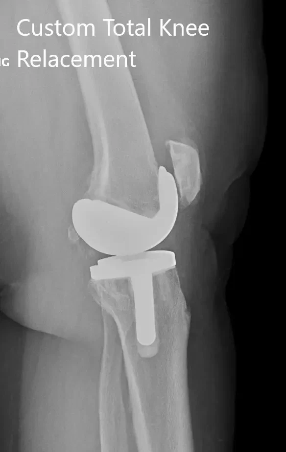 Postoperative X-ray showing the lateral views of both knees Postoperative X-ray showing the lateral views of both knees