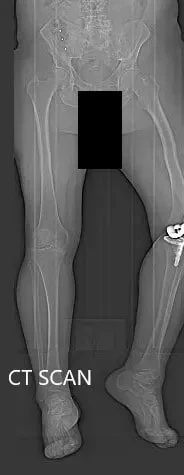 Preoperative topography CT scan images of the lower extremities Preoperative topography CT scan images of the lower extremities