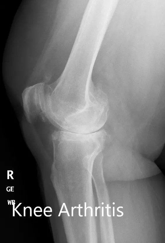 Preoperative X-ray of the right knee showing AP and lateral views - img 2 Preoperative X-ray of the right knee showing AP and lateral views - img 2