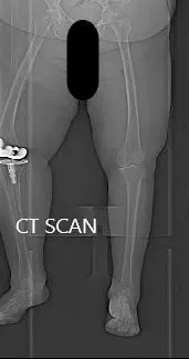 Topogram image of the patients lower extremities, suggesting severe tricompartmental osteoarthritis of the left knee Topogram image of the patients lower extremities, suggesting severe tricompartmental osteoarthritis of the left knee
