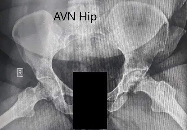 Radiografía preoperatoria de la pelvis con ambas caderas en la vista lateral con patas de rana mostrando cambios en el AVN en la cadera izquierda