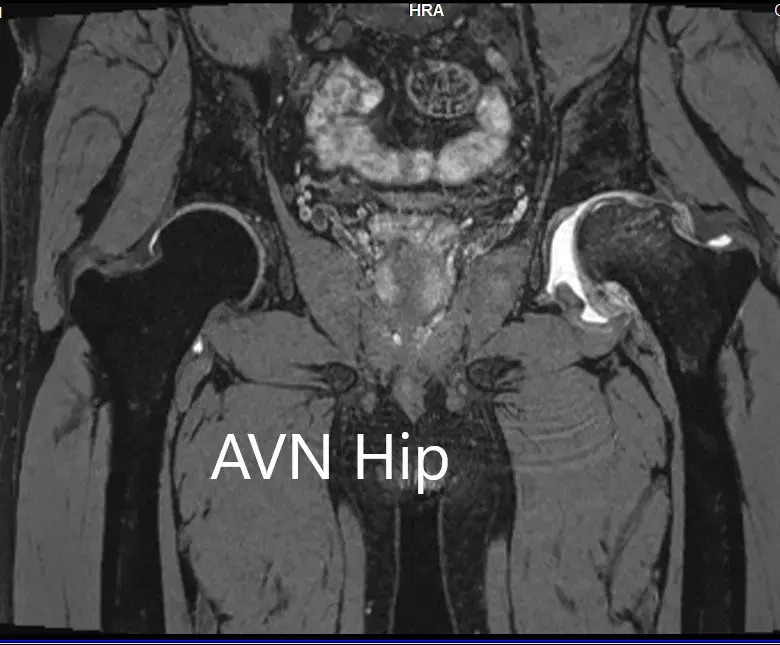 Imágenes de resonancia magnética que muestran necrosis avascular de la cadera izquierda con colapso - escáner 3