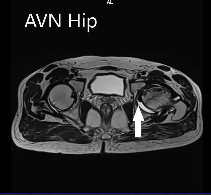 Imágenes de resonancia magnética que muestran necrosis avascular de la cadera izquierda con colapso - escáner 4