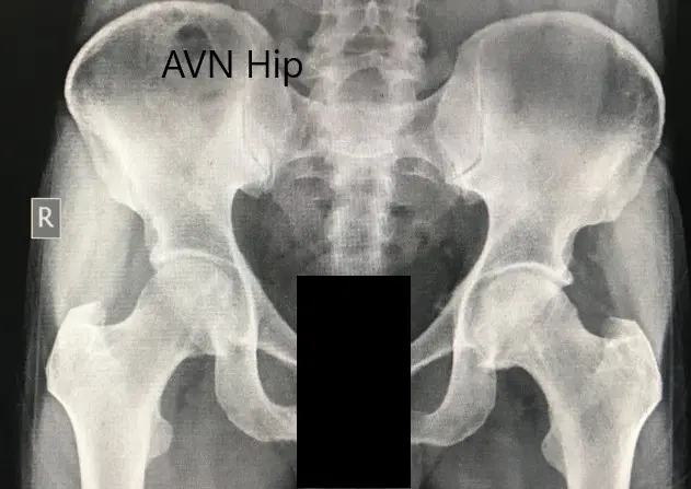 Radiografía preoperatoria de la pelvis con ambas caderas en vista anteroposterior que muestra el AVN de las caderas bilaterales