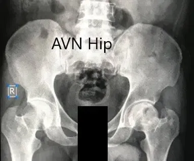 Radiografía preoperatoria de la pelvis con ambas caderas en vista anteroposterior que muestra el AVN de la cadera izquierda Radiografía preoperatoria de la pelvis con ambas caderas en vista anteroposterior que muestra el AVN de la cadera izquierda