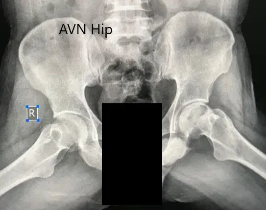 Radiografía preoperatoria de la pelvis con ambas caderas en la vista lateral con patas de rana que muestra el AVN de la cadera izquierda Radiografía preoperatoria de la pelvis con ambas caderas en la vista lateral con patas de rana que muestra el AVN de la cadera izquierda