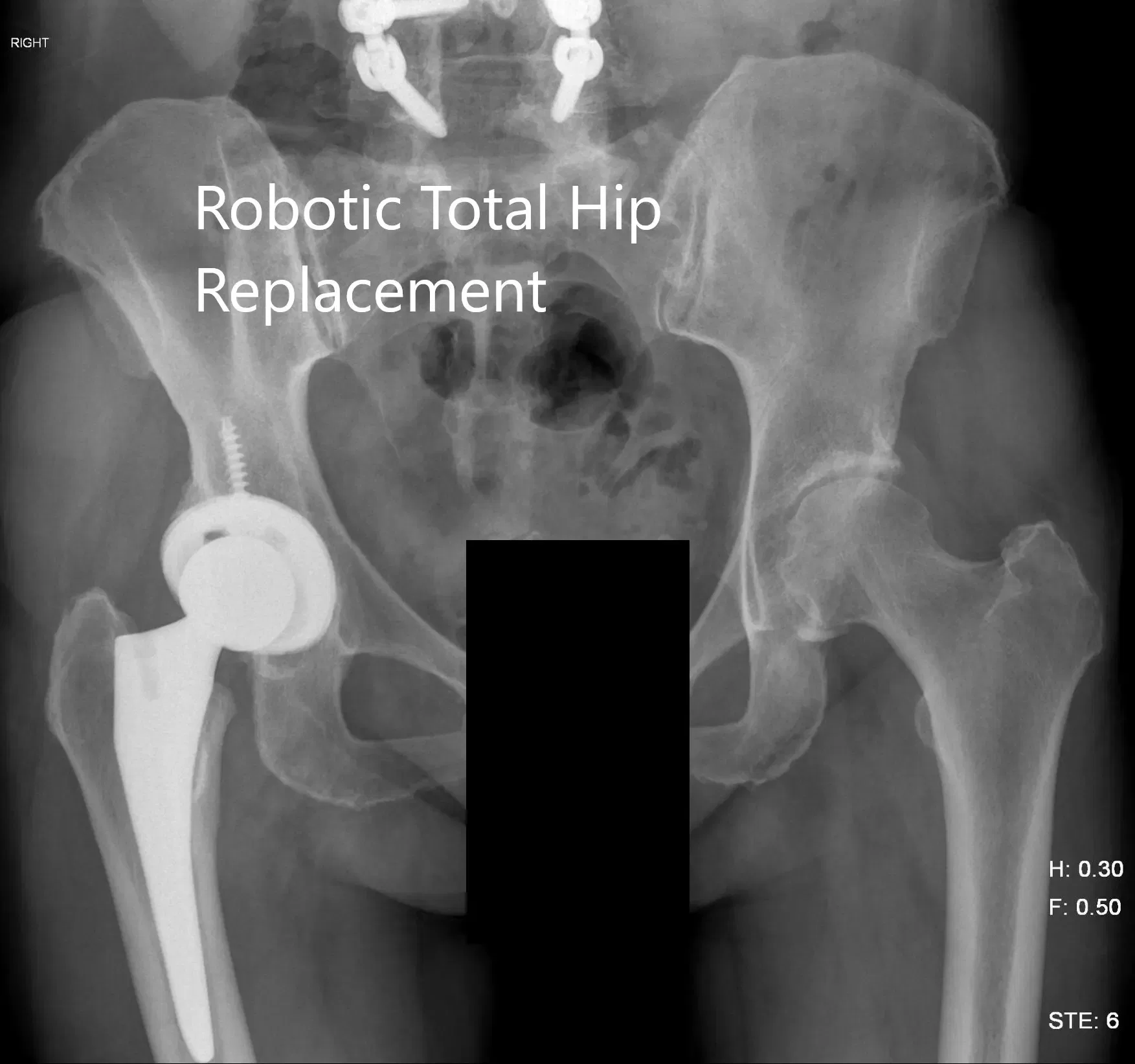 Radiografía postoperatoria de la pelvis mostrando vista AP