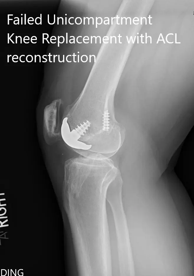 Radiografía preoperatoria que muestra las vistas anteroposterior y lateral de la rodilla derecha - img 2 Radiografía preoperatoria que muestra las vistas anteroposterior y lateral de la rodilla derecha - img 2
