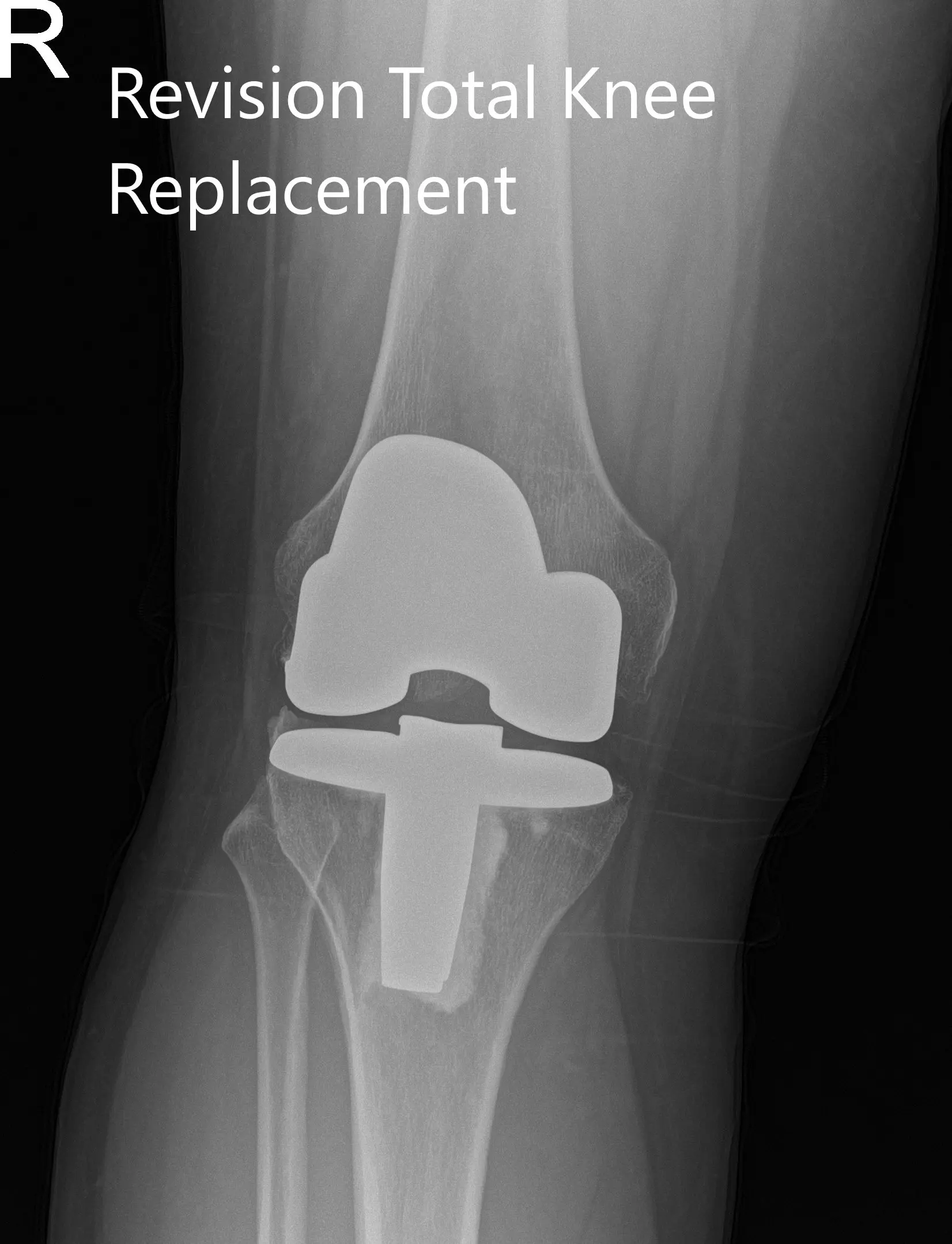 Radiografía postoperatoria que muestra las vistas anteroposterior y lateral de la rodilla derecha Radiografía postoperatoria que muestra las vistas anteroposterior y lateral de la rodilla derecha