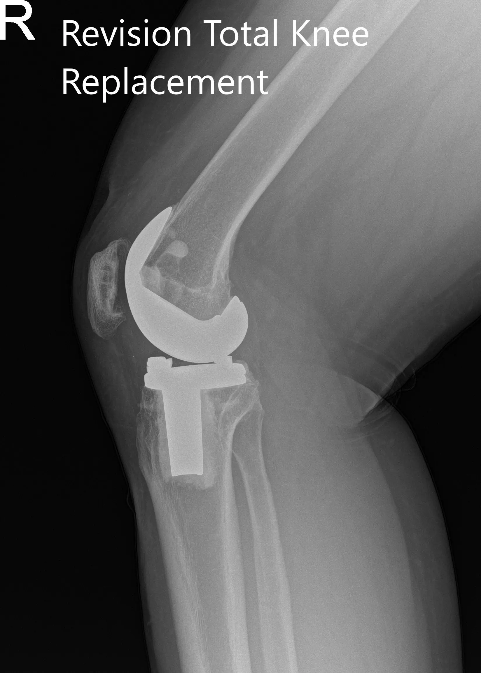 Radiografía postoperatoria que muestra las vistas anteroposterior y lateral de la rodilla derecha - img 2 Radiografía postoperatoria que muestra las vistas anteroposterior y lateral de la rodilla derecha - img 2