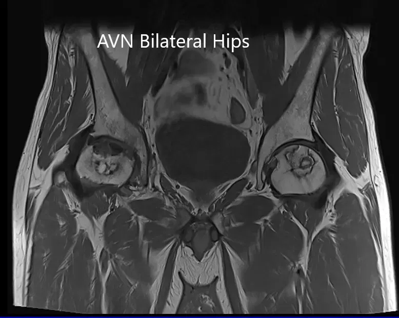 Resonancia magnética que muestra AVN bilateral de la cabeza femoral en T1WI Resonancia magnética que muestra AVN bilateral de la cabeza femoral en T1WI
