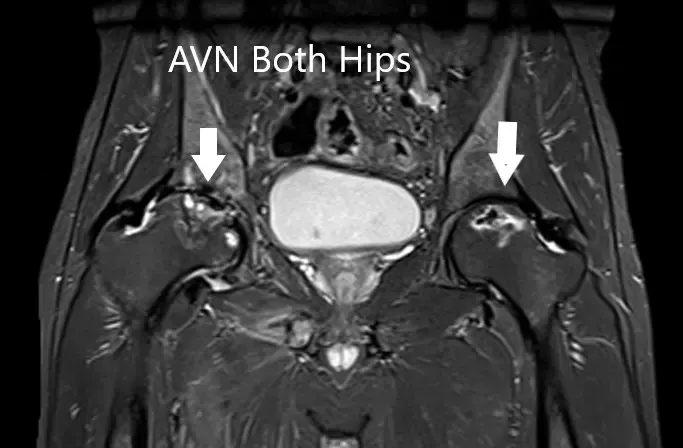 La resonancia magnética muestra un AVN bilateral femoral en T2WI