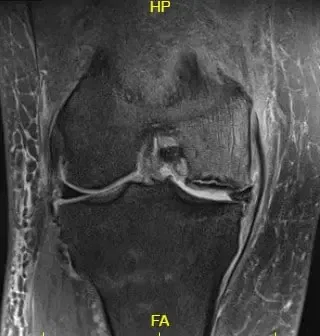 Imagen ponderada en T2 que muestra la sección coronal de la rodilla con la señal alterada de la médula ósea y la señal del borde