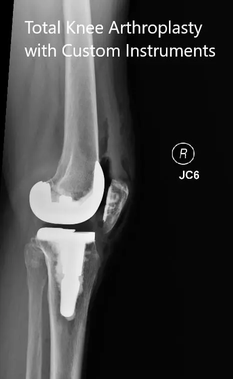 Radiografías postoperatorias que muestran las vistas anteroposterior y lateral de la rodilla derecha - IMG 2
