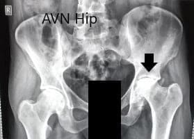 Preoperative X-ray of the pelvis with both hips in anteroposterior view Preoperative X-ray of the pelvis with both hips in anteroposterior view