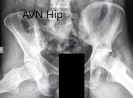 Preoperative X-ray of the pelvis with both hips in frog-legged lateral views Preoperative X-ray of the pelvis with both hips in frog-legged lateral views