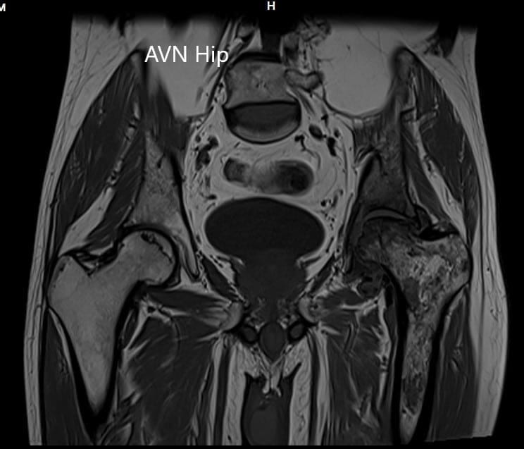 MRI showing the T1WI of the pelvis MRI showing the T1WI of the pelvis