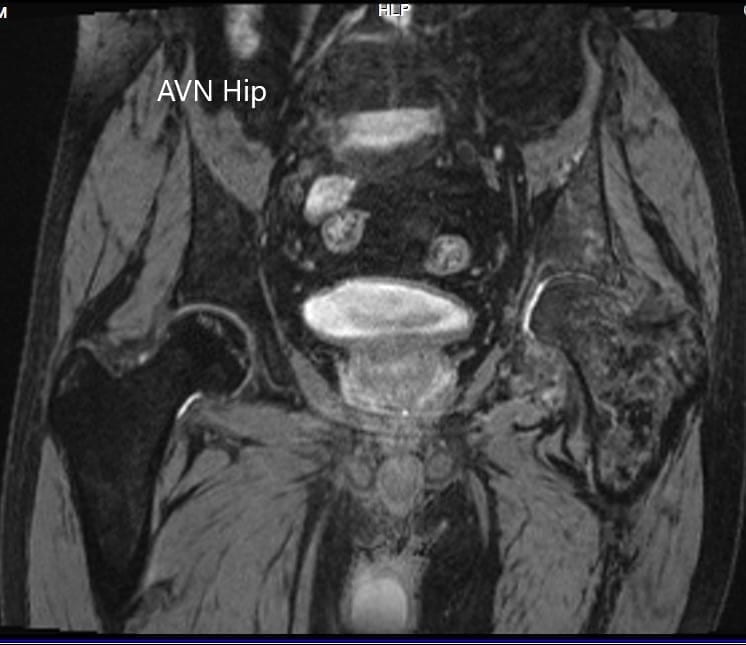 MRI showing the T2WI of the pelvis MRI showing the T2WI of the pelvis
