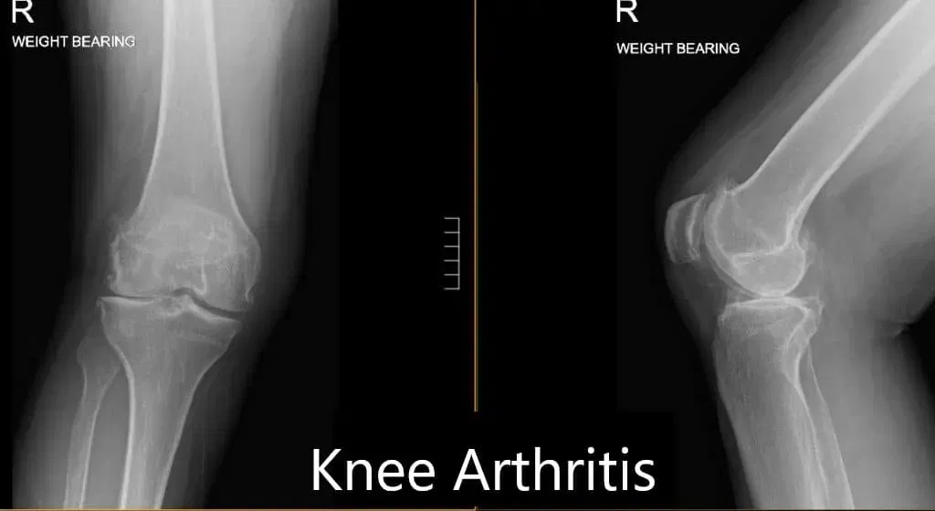 Right total knee arthroplasty