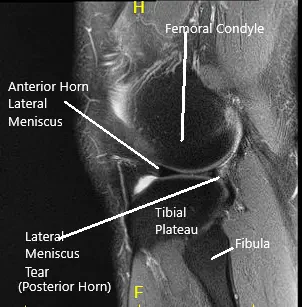 Resonancia magnética de rodilla en secciones coronal y sagital 2